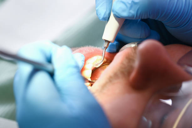 Best Urgent Care for Lost Fillings or Crowns in Rock Springs, WY